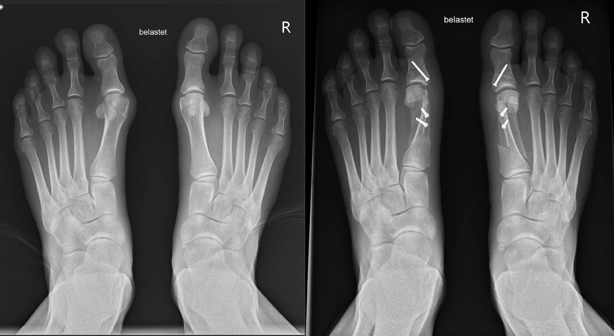 X-ray of the feet before and after the operation. The difference could hardly be clearer.