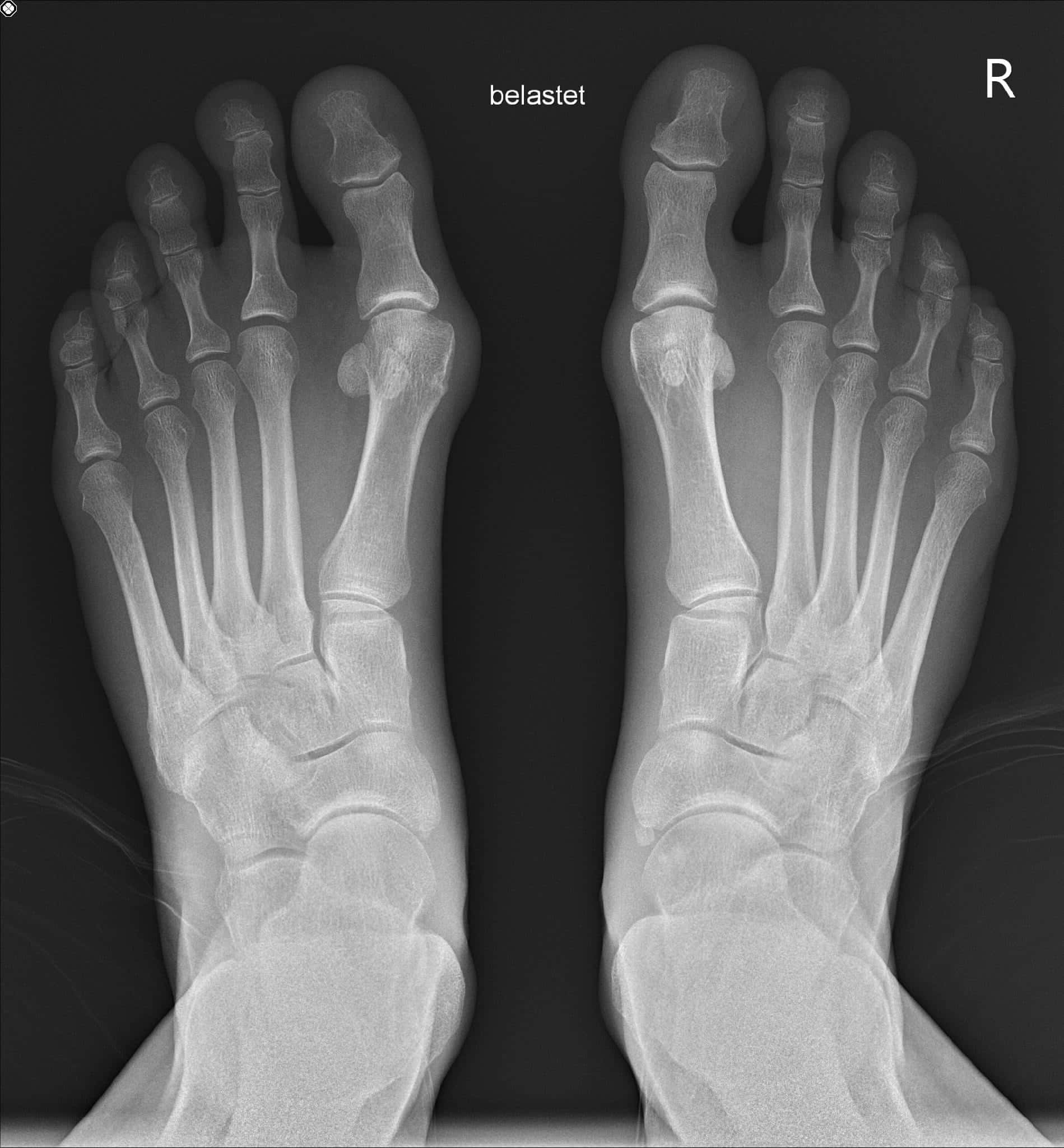 Pictures speak volumes: The x-ray shows the deformation on both feet. 